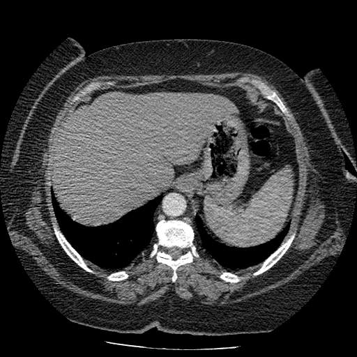 Bovine aortic arch - right internal mammary vein drains into the superior vena cava (Radiopaedia 63296-71875 A 145).jpg