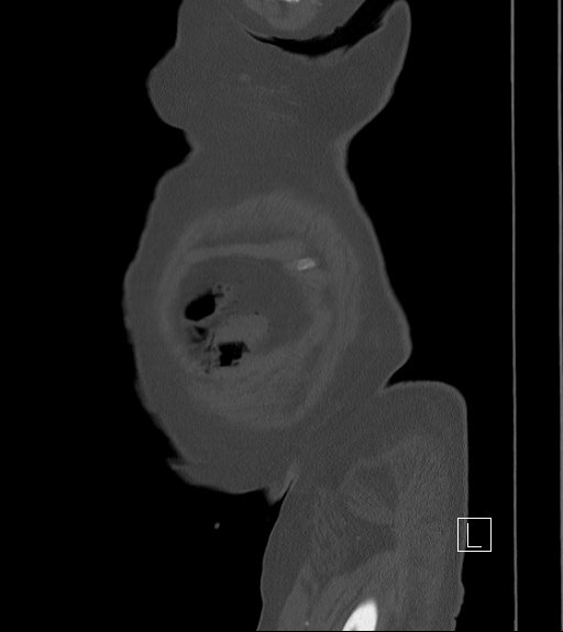 File:Bowel ischemia secondary to SMA occlusion with extensive portomesenteric venous gas (Radiopaedia 54656-60871 Sagittal bone window 112).jpg