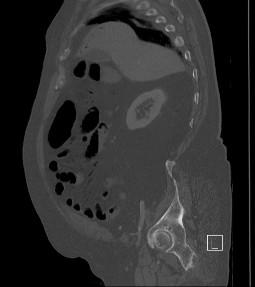 Bowel ischemia secondary to SMA occlusion with extensive portomesenteric venous gas (Radiopaedia 54656-60871 Sagittal bone window 82).jpg