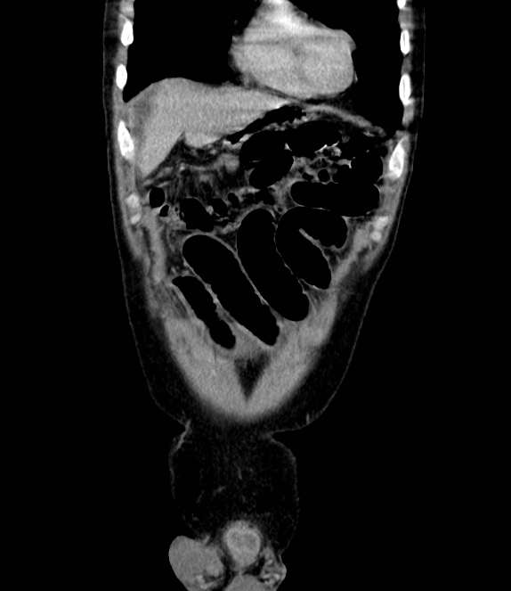 Bowel obstruction from colon carcinoma (Radiopaedia 22995-23028 C 12).jpg