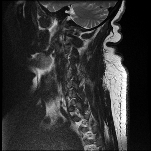 File:Brachial plexopathy (Radiopaedia 21844-21806 Sagittal T2 1).jpg