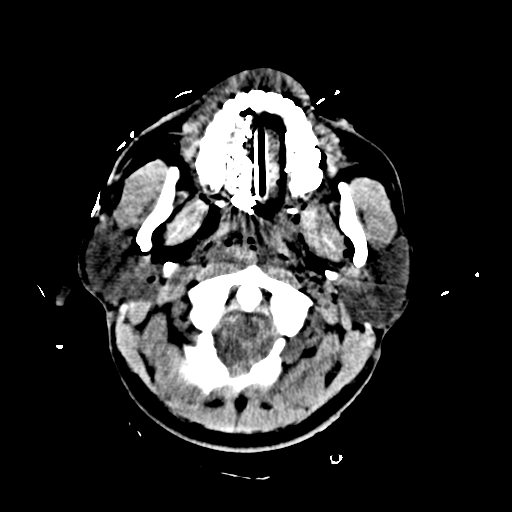 File:Brain contusions, internal carotid artery dissection and base of skull fracture (Radiopaedia 34089-35339 Axial non-contrast 14).png