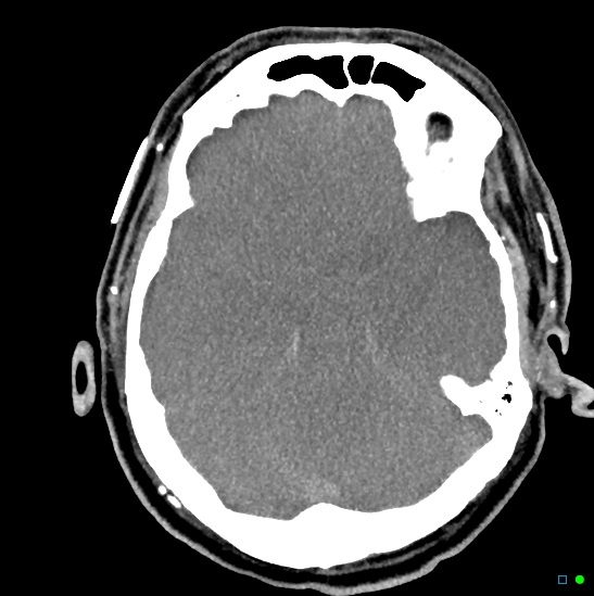 Brain death on MRI and CT angiography (Radiopaedia 42560-45841 B 33).jpg