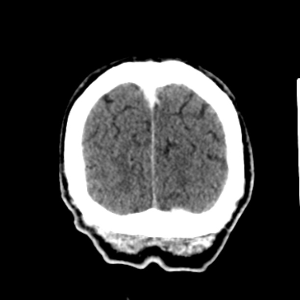 Brain metastases from lung cancer (Radiopaedia 27849-28092 Coronal C+ delayed 62).jpg