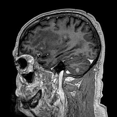 Brain metastases from lung cancer (Radiopaedia 83839-99028 Sagittal T1 C+ 16).jpg