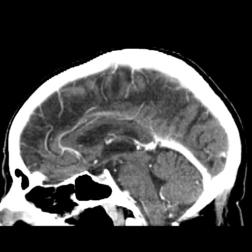 Brain metastasis (Radiopaedia 42617-45760 D 26).jpg