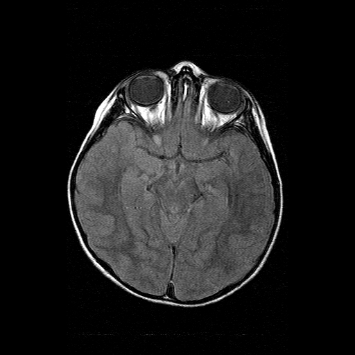 File:Brainstem ganglioglioma (Radiopaedia 10763-11224 Axial FLAIR 12).jpg