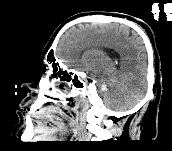Brainstem hemorrhage (Radiopaedia 81294-94976 C 23).jpg