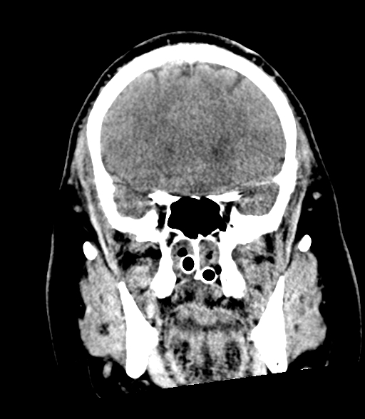 Brainstem hemorrhage (Radiopaedia 81294-94976 Coronal non-contrast 22).jpg
