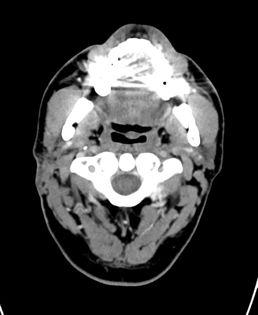Branchial cleft cyst (Radiopaedia 31167-31875 Axial C+ delayed 14).jpg