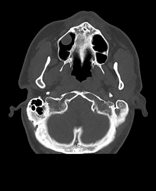 Branchial cleft cyst (Radiopaedia 31167-31875 Axial bone window 13).jpg