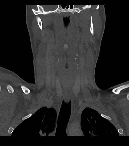 Branchial cleft cyst (Radiopaedia 31167-31875 Coronal bone window 34).jpg