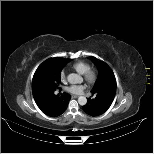 Breast cancer on thorax CT (Radiopaedia 60571-68275 A 55).JPG