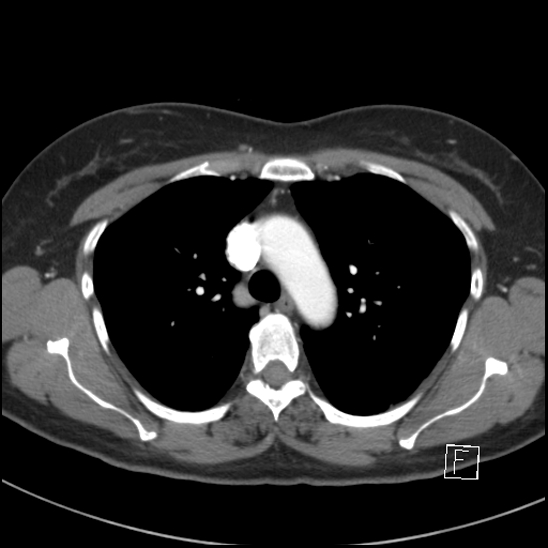 Breast metastases from renal cell cancer (Radiopaedia 79220-92225 A 30).jpg