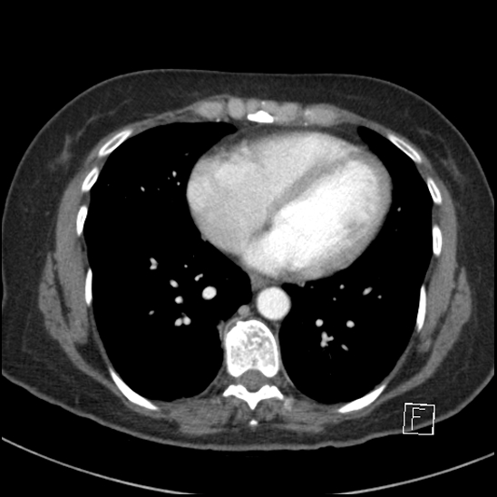 Breast metastases from renal cell cancer (Radiopaedia 79220-92225 A 61).jpg