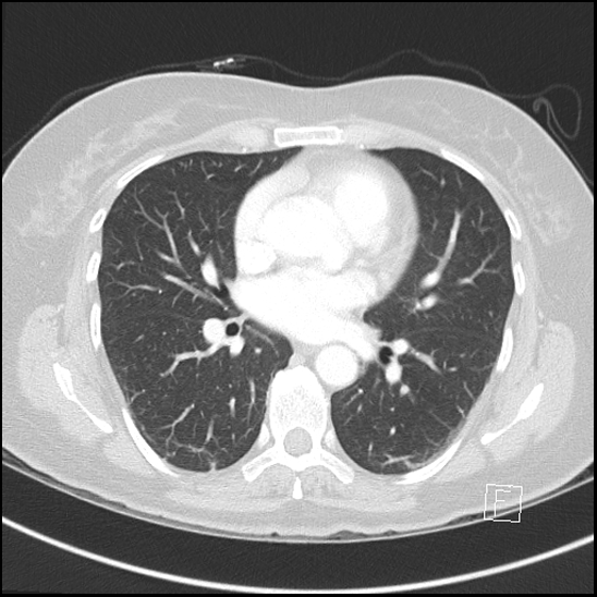 Breast metastases from renal cell cancer (Radiopaedia 79220-92225 Axial lung window 46).jpg