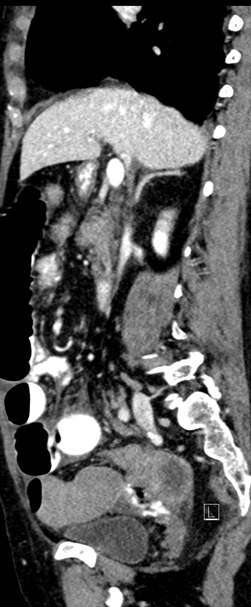 Broad ligament hernia (Radiopaedia 84802-100276 C 48).jpg