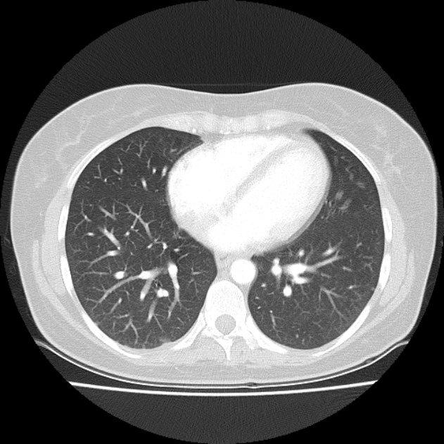 Bronchial atresia (Radiopaedia 22965-22992 Axial lung window 19).jpg