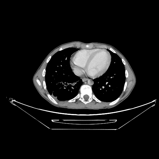 Bronchial carcinoid tumor (Radiopaedia 57187-64090 A 56).jpg