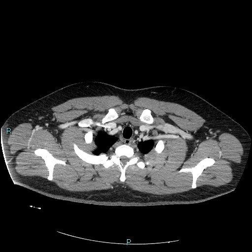 Bronchial carcinoid tumor (Radiopaedia 78272-90875 A 18).jpg