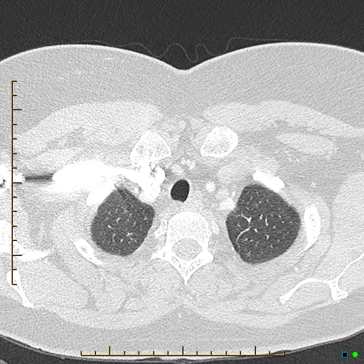 File:Bronchial diverticula (Radiopaedia 79512-92676 Axial lung window 11).jpg