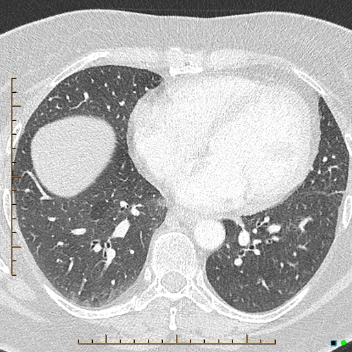 Bronchial diverticula (Radiopaedia 79512-92676 Axial lung window 133).jpg