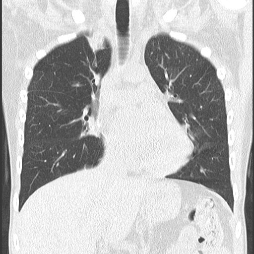 File:Bronchiolotis obliterans (Radiopaedia 73769-84575 Coronal lung window 18).jpg