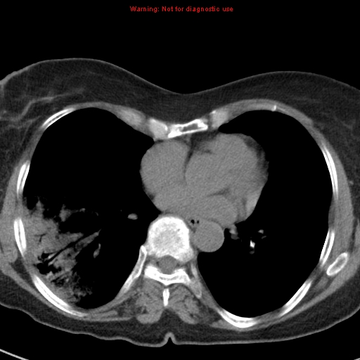 File:Bronchoalveolar carcinoma (BAC) (Radiopaedia 13436-13392 Axial non-contrast 32).jpg
