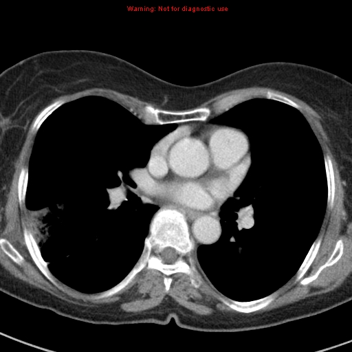 File:Bronchoalveolar carcinoma (BAC) (Radiopaedia 13436-13392 B 28).jpg