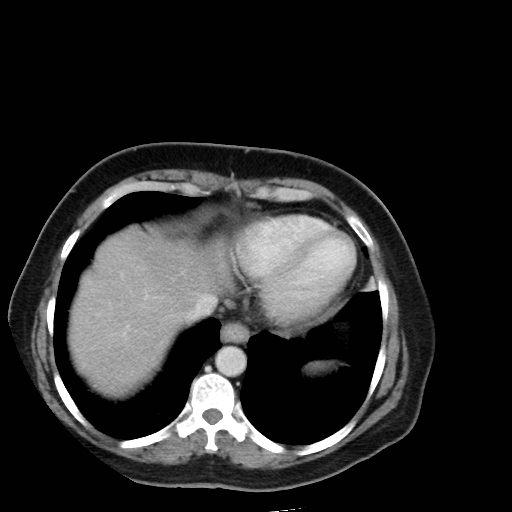 Bronchogenic carcinoma (Radiopaedia 73497-84262 A 49).jpg