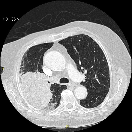 Bronchogenic carcinoma as an incidental finding (Radiopaedia 16453-16130 Axial lung window 76).jpg