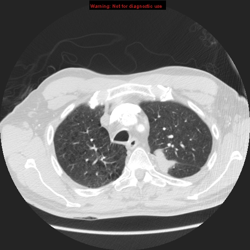 File:Bronchogenic carcinoma brain metastasis (Radiopaedia 9286-105832 Axial lung window 24).jpg