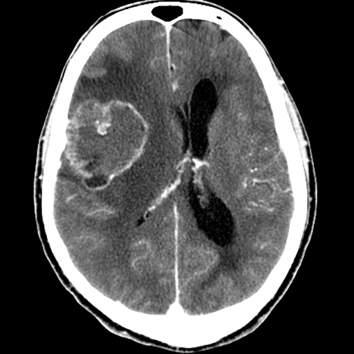 File:Bronchogenic carcinoma brain metastasis (Radiopaedia 9286-9970 A 1).jpg
