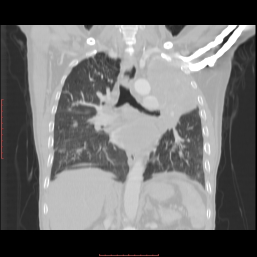 File:Bronchogenic carcinoma with left atrial large deposit - T4N3M1a (Radiopaedia 42316-45428 Coronal lung window 10).jpg