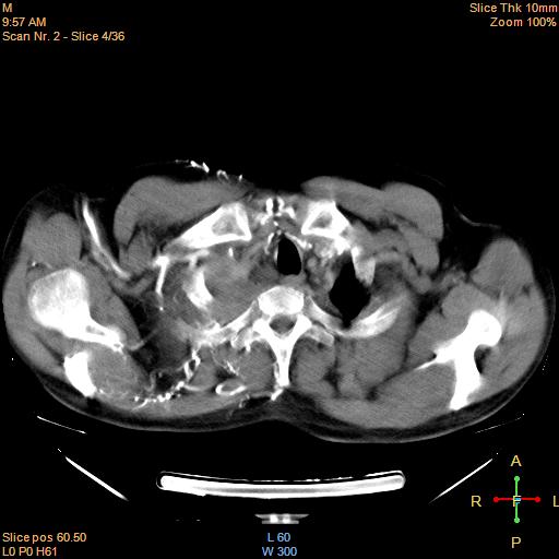 File:Bronchogenic carcinoma with superior vena caval invasion (Radiopaedia 22378-22406 Mediastinal window 2).jpg
