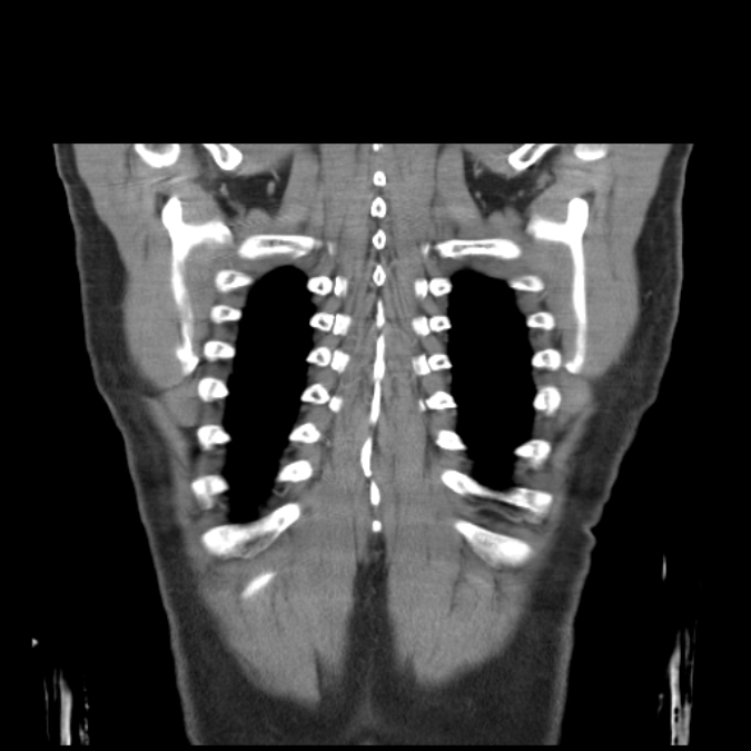 Bronchogenic carcinoma with upper lobe collapse (Radiopaedia 29297-29726 D 50).jpg