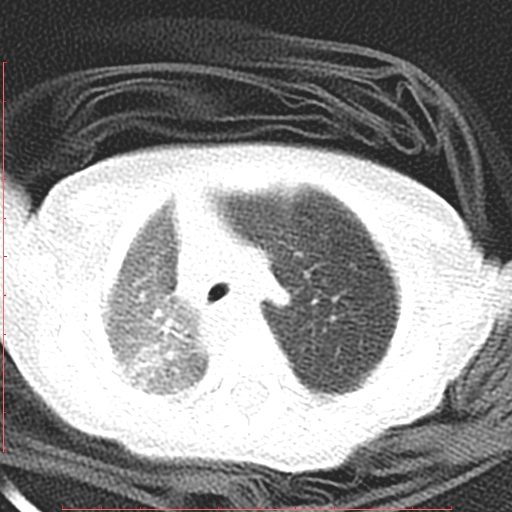 File:Bronchogenic cyst (Radiopaedia 78599-91409 Axial lung window 42).jpg