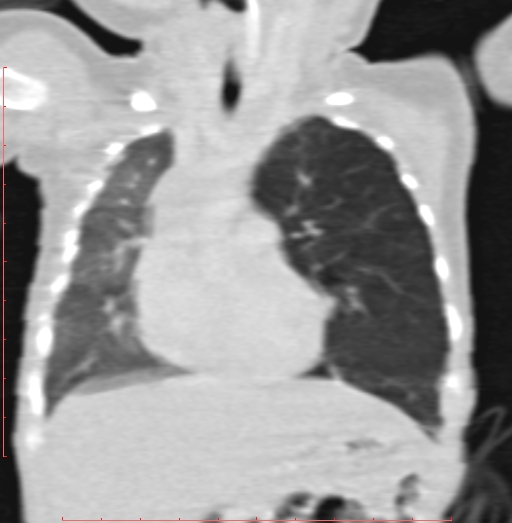 Bronchogenic cyst (Radiopaedia 78599-91409 Coronal lung window 96).jpg