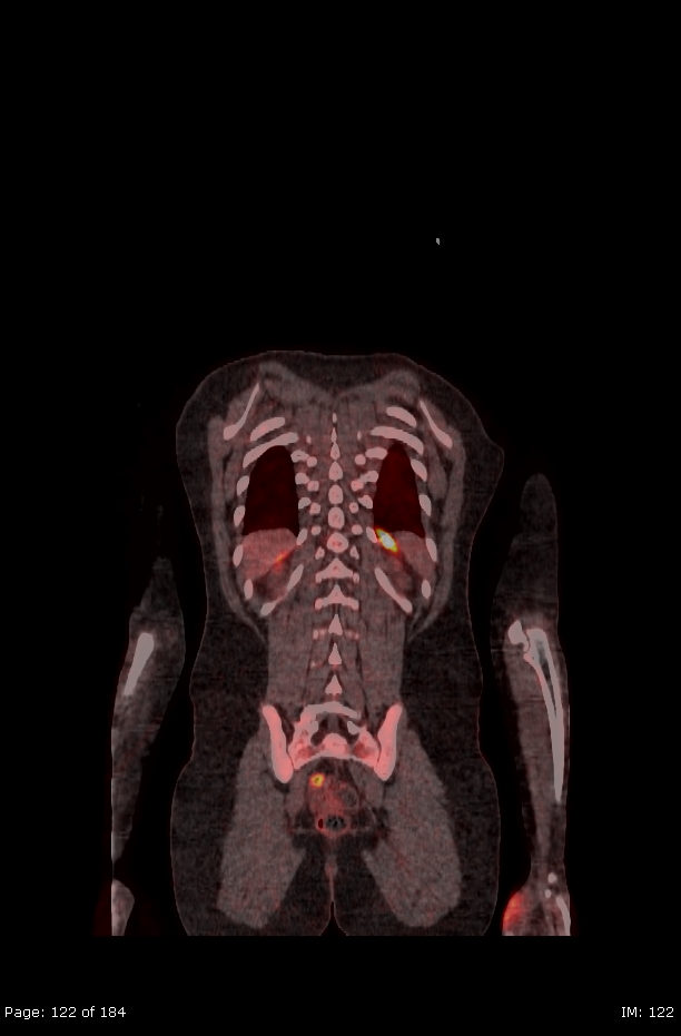 Brown fat uptake (FDG PET-CT) (Radiopaedia 77392-89513 Fused coronal 80).jpg