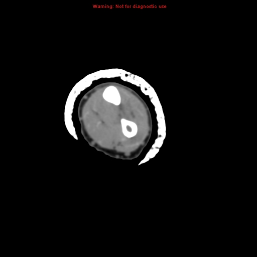 Brown tumor (Radiopaedia 12460-12694 Axial non-contrast 87).jpg