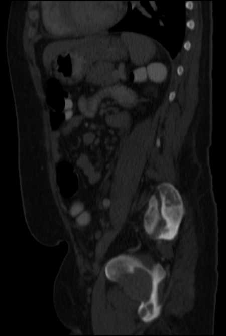 Brown tumors compressing the spinal cord (Radiopaedia 68442-77988 H 37).jpg