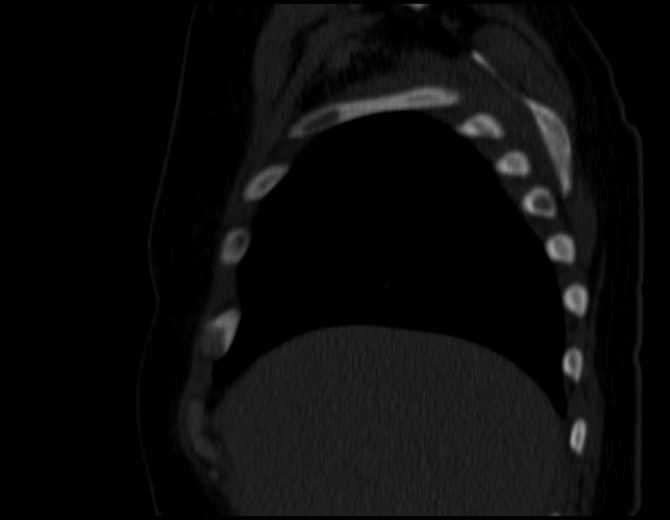 Brown tumors compressing the spinal cord (Radiopaedia 68442-77988 Sagittal bone window 13).jpg