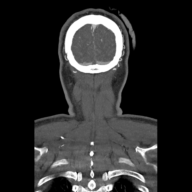 Buccal fat pad arteriovenous malformation (Radiopaedia 70936-81144 B 54).jpg
