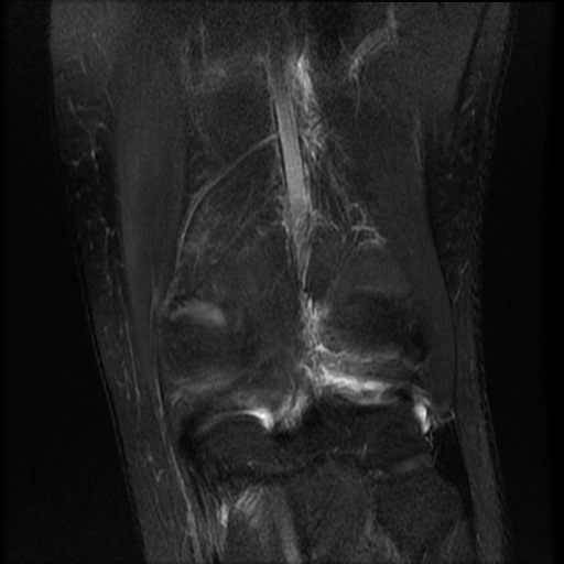 File:Bucket-handle meniscus tear (Radiopaedia 65700-74809 Coronal T2 fat sat 5).jpg