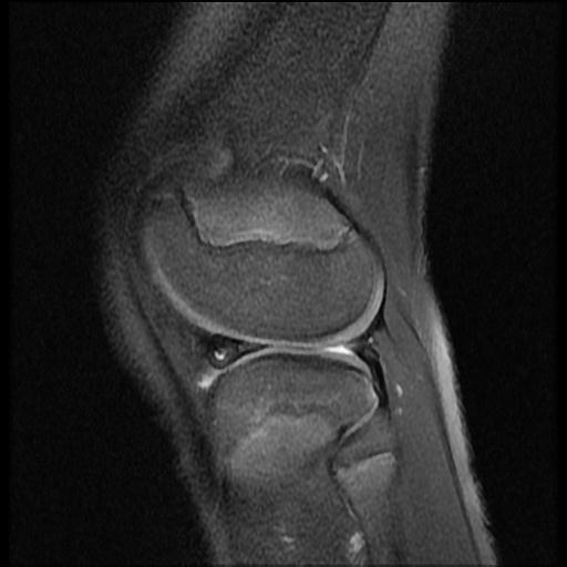 File:Bucket handle tear - lateral meniscus (Radiopaedia 72124-82634 Sagittal PD fat sat 3).jpg