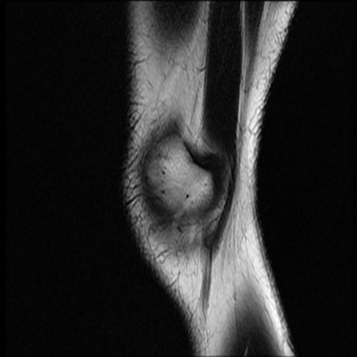 File:Bucket handle tear - lateral meniscus (Radiopaedia 72124-82634 Sagittal T2 16).jpg