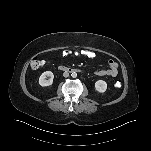 Buried bumper syndrome - gastrostomy tube (Radiopaedia 63843-72575 A 41).jpg