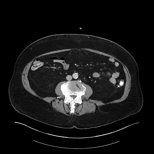 File:Buried bumper syndrome - gastrostomy tube (Radiopaedia 63843-72575 A 52).jpg