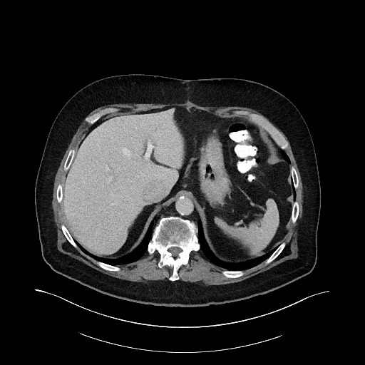 Buried bumper syndrome - gastrostomy tube (Radiopaedia 63843-72575 A 8).jpg