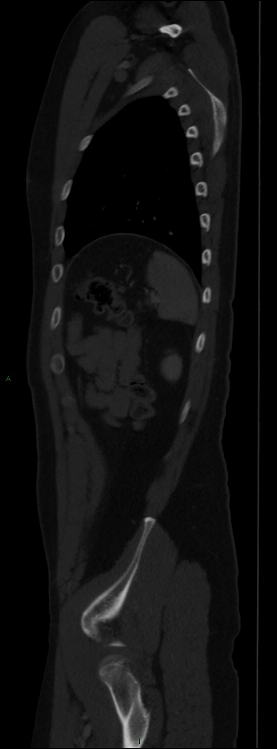 Burst fracture (Radiopaedia 83168-97542 Sagittal bone window 100).jpg